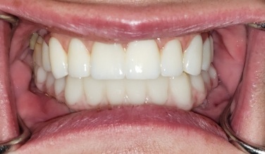 Smile with replaced bottom teeth