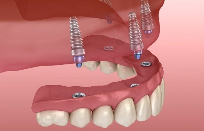 Model all on four dental implant supported denture