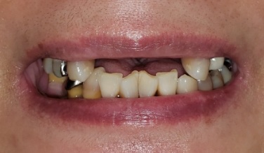 Smile with missing bottom teeth