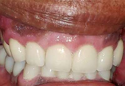 Smile after replacing missing teeth