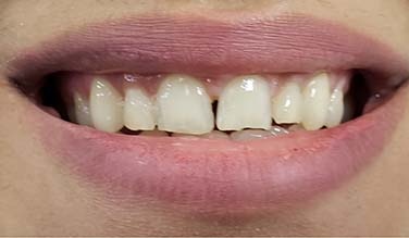 Chipped and gapped smile before cosmetic dentistry