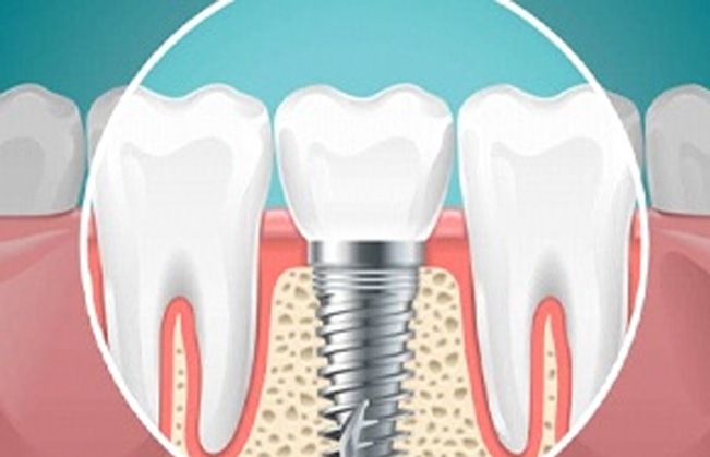 Animated dental implant supported dental crown