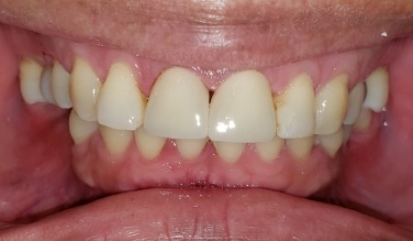 Smile with replaced bottom teeth