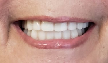 Smile with replaced bottom teeth