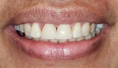 Smile with replaced bottom teeth
