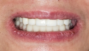 Smile with replaced bottom teeth