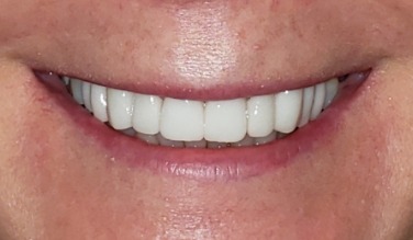 Smile with replaced bottom teeth