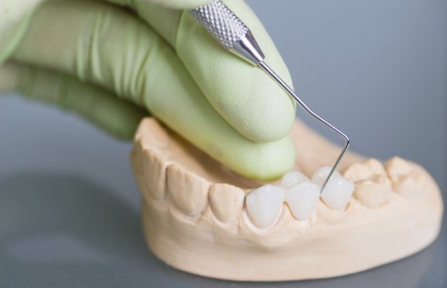 Model smile with a dental crown supported fixed bridge restoration