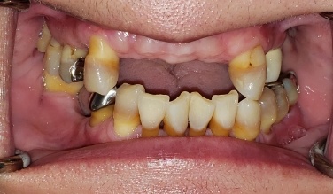 Smile with missing bottom teeth