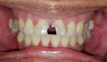 Smile with missing bottom teeth