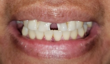 Smile with missing bottom teeth