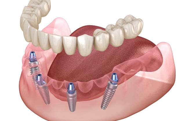 Implant dentures  
