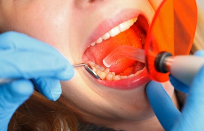 Dental patient receiving veneers