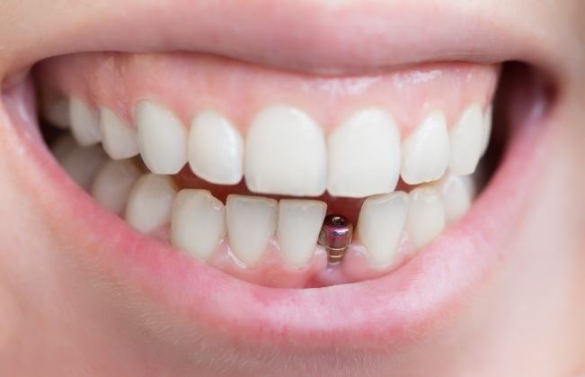 Closeup of smile with mini dental implants
