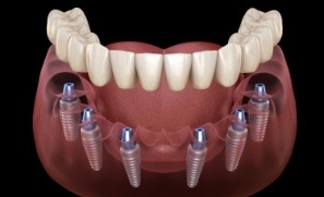 Animated smiling during dental implant supported denture placement