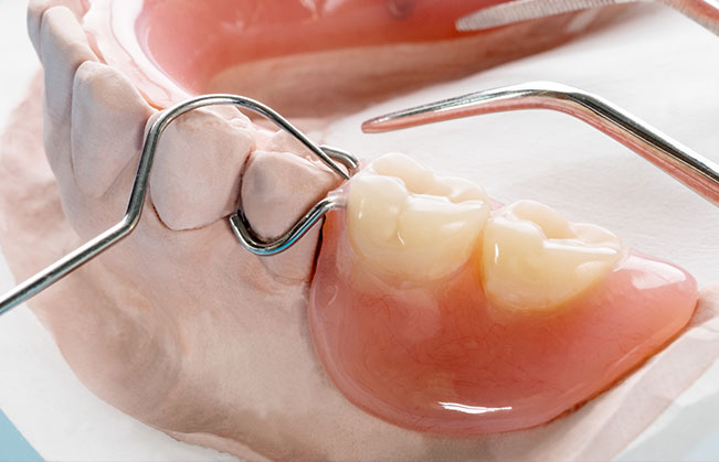 Partial denture on smile model