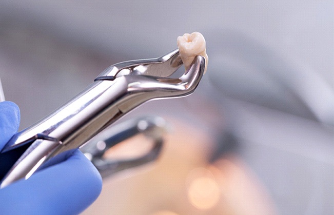 Forceps holding a tooth after tooth extraction in Kent, WA