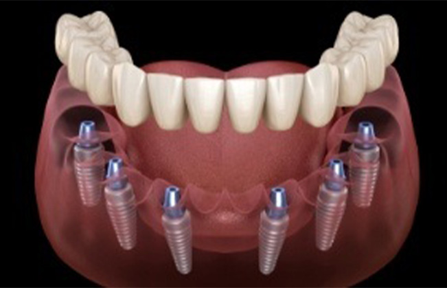 Woman discussing full mouth reconstruction options with dentist