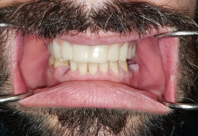 Smile with full mouth dental implants