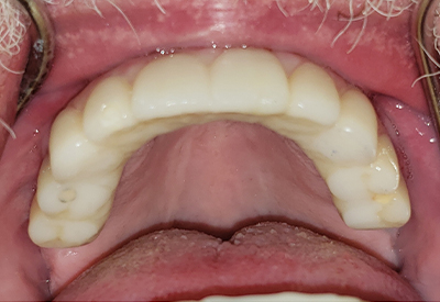 Closeup of the inside of mouth after tooth replacement