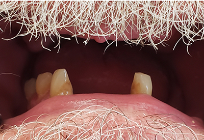 Smile extensive tooth loss and damage