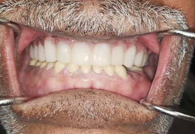 Smile with full mouth dental implants