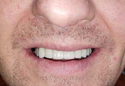 Smile fully restored with full mouth dental implants