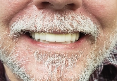 Smile with full mouth dental implants