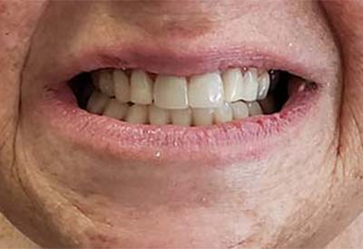Healthy smile after full mouth dental implants