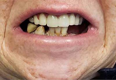 Smile with missing teeth and wide spread dental decay and damage
