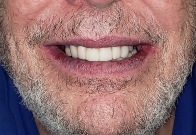 Smile with full mouth dental implants