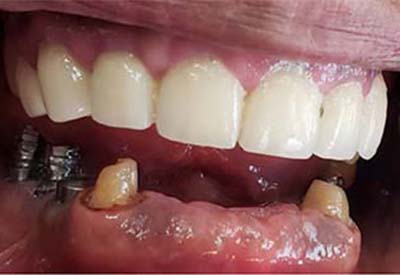 Smile with advanced tooth loss