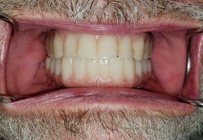 Smile with full mouth dental implants