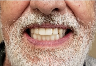 Smile with full mouth dental implants