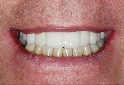 Picture perfect smile after full mouth dental implants