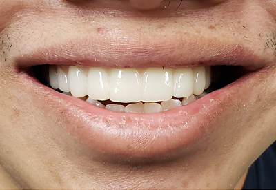 Healthy bright smile after replacing top teeth