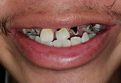 Missing top row of teeth
