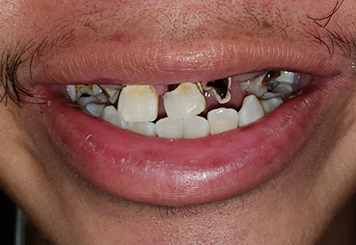 Severely damaged and decayed top teeth