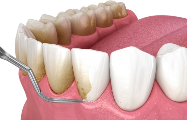 Animated smile during scaling and root planing treatment