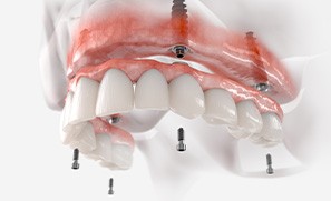Illustration of fixed implant denture for upper dental arch