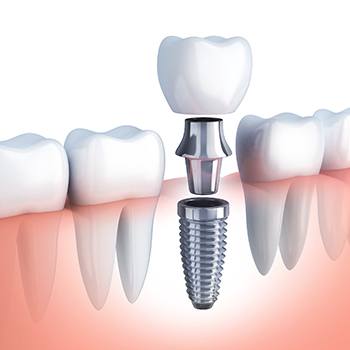 Implant post, abutment, and crown