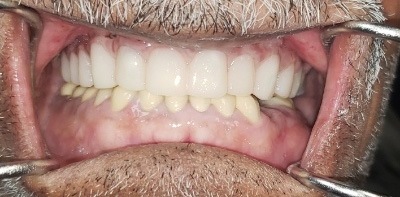 Healthy perfected smile after cosmetic dentistry