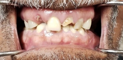 Damaged and decayed smile before cosmetic dentistry