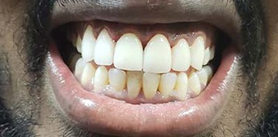 Healthy perfected smile after cosmetic dentistry