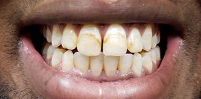 Damaged and decayed smile before cosmetic dentistry