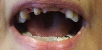 Damaged and decayed smile before cosmetic dentistry