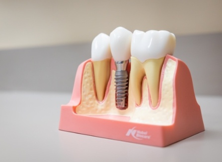 Model dental implant supported dental crown