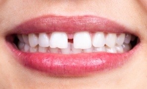 Closeup of smile with gaps between teeth