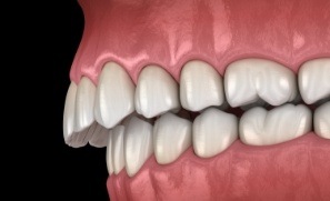 Animated smile with bite alignment issues