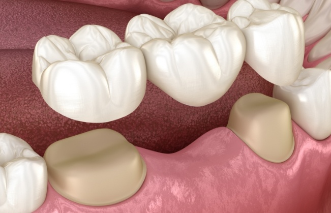 Animated smile during dental bridge placement